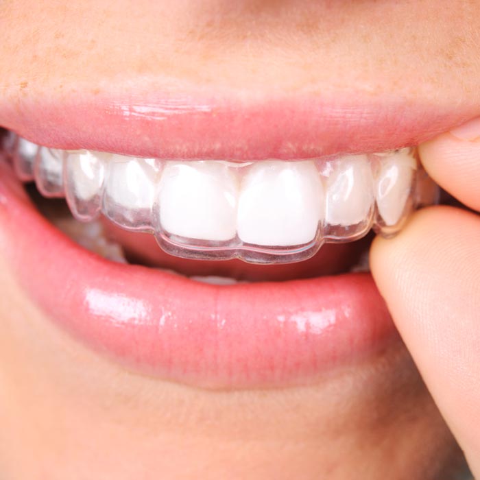 Invisalign clear aligners